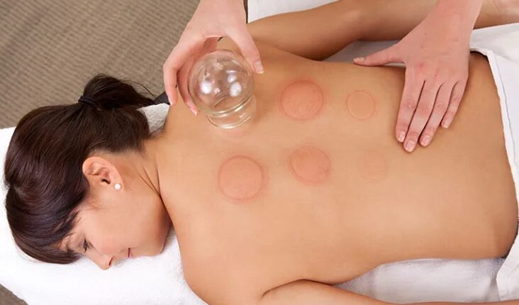 Person receiving cupping therapy on back with multiple circular marks, lying face down on a massage table.