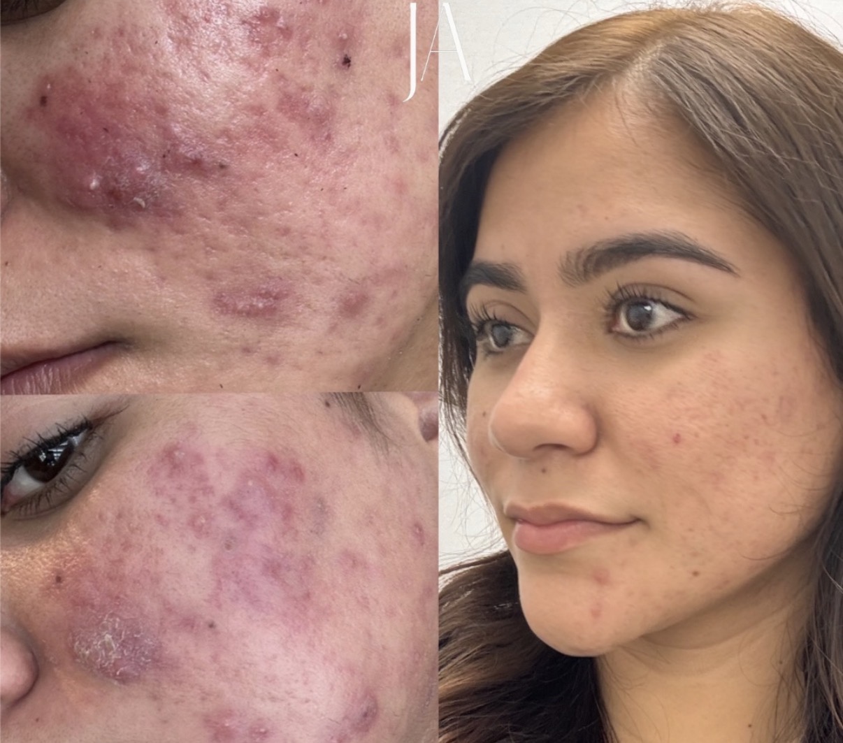 Side profile of a young woman with clear skin, showing before and after images of acne treatment, with visible improvement.