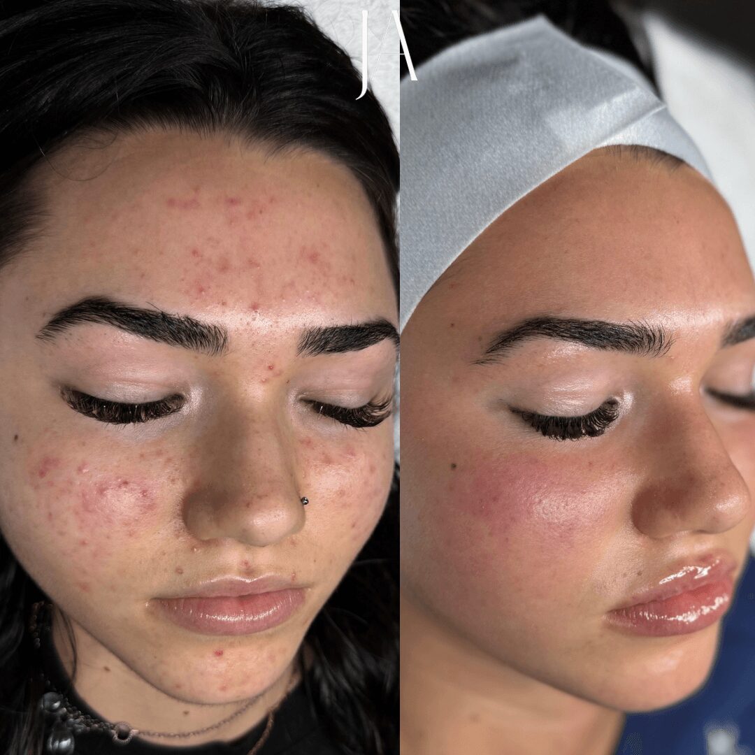 Side-by-side comparison of a woman's face before and after skincare treatment, showing clear skin and improved complexion.