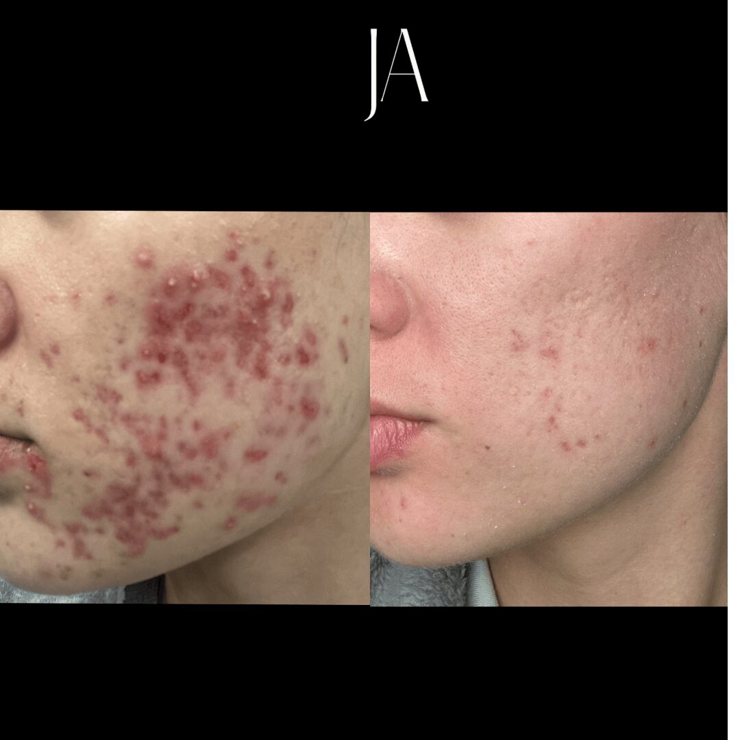 Comparison of skin with severe acne and improved skin after treatment, showing reduced redness and inflammation.